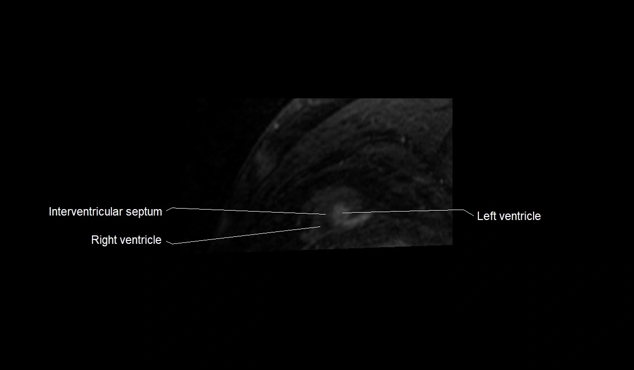 MRI heart and coronary arteries short axis anatomy image 40.webp